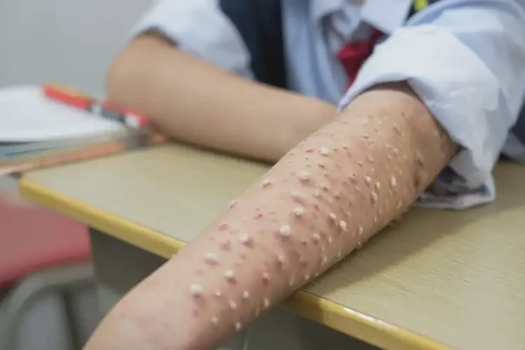 中學生四肢容易長濕疹可不可以根治(圖4)