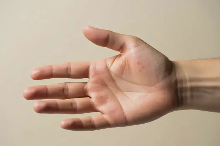 青年人手上长湿疹可不可以根治(图4)