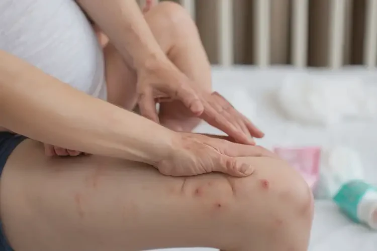 哺乳期媽媽手上起濕疹能不能根治(圖4)