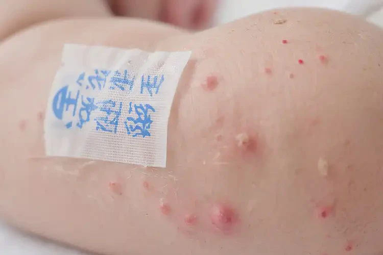 嬰兒身上經(jīng)常起濕疹可不可以根治(圖4)