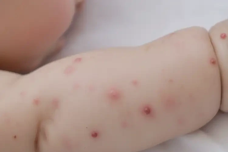 嬰幼兒手臂容易長濕疹可以治好嗎(圖4)