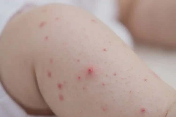 寶寶屁股上起濕疹可不可以根治(圖4)