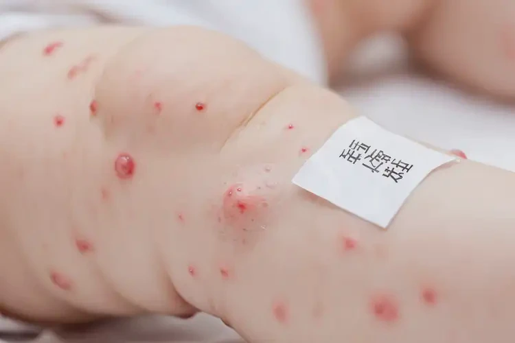 嬰兒小腿偶爾起濕疹可以治好嗎(圖4)