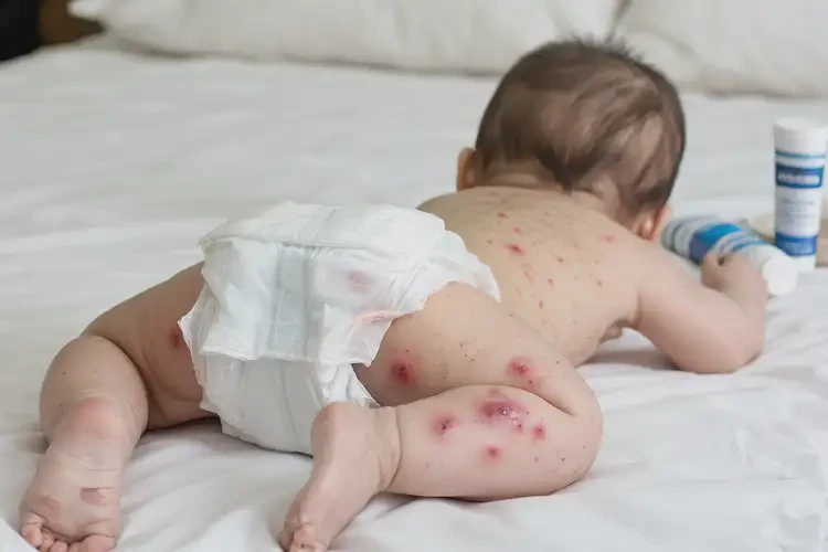 嬰幼兒屁股上偶爾起濕疹能夠徹底治愈嗎(圖4)