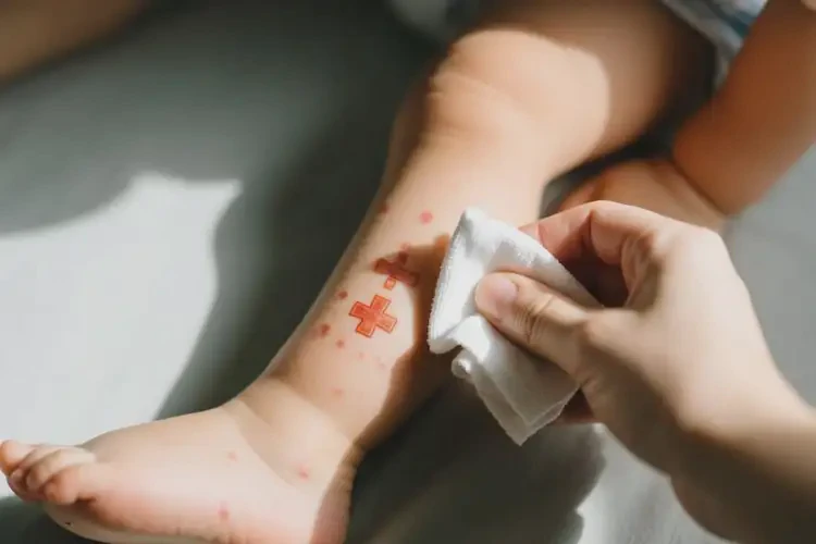 幼兒大腿上出現(xiàn)濕疹可不可以根治(圖2)