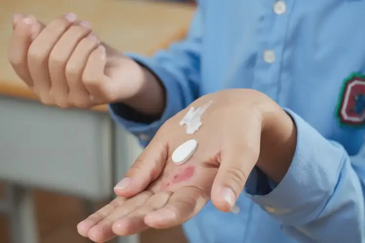 中学生手上出湿疹可不可以根治(图3)