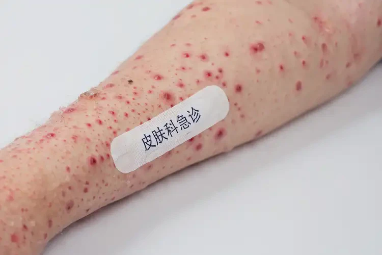 大学生手臂长湿疹能不能彻底自愈(图4)