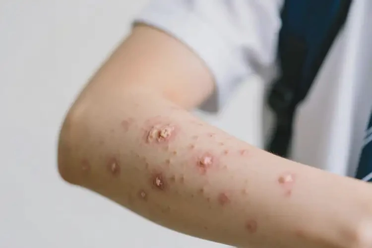 大學(xué)生手臂上偶爾長濕疹可不可以根治(圖1)
