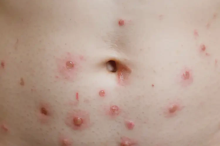 兒童肚子偶爾長濕疹可不可以根治(圖3)