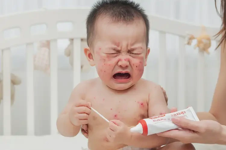 嬰幼兒肛周容易長(zhǎng)濕疹可以治好嗎(圖4)
