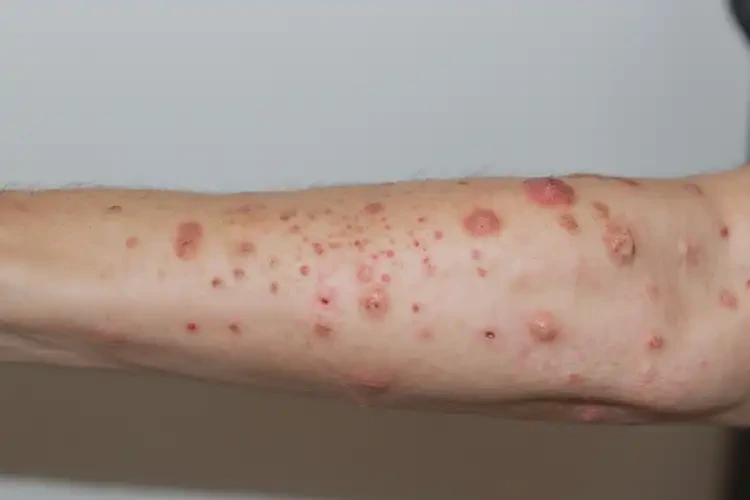 女性手臂出濕疹可以徹底自愈嗎(圖4)