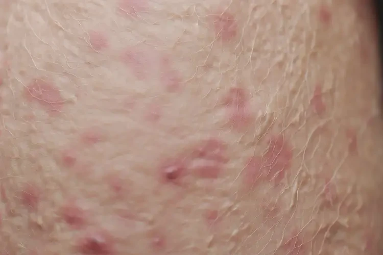 高齡老人大腿上偶爾長濕疹可不可以根治(圖4)