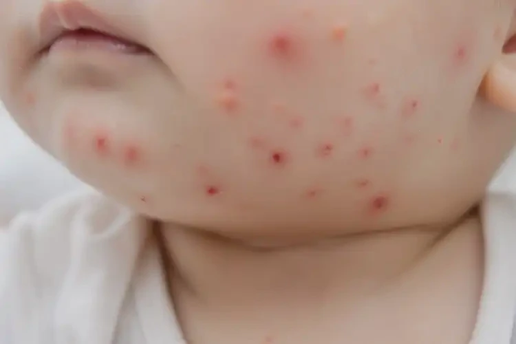 嬰幼兒脖子上容易起濕疹可以治好嗎(圖4)