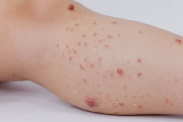 少兒大腿上起濕疹可不可以根治(圖3)