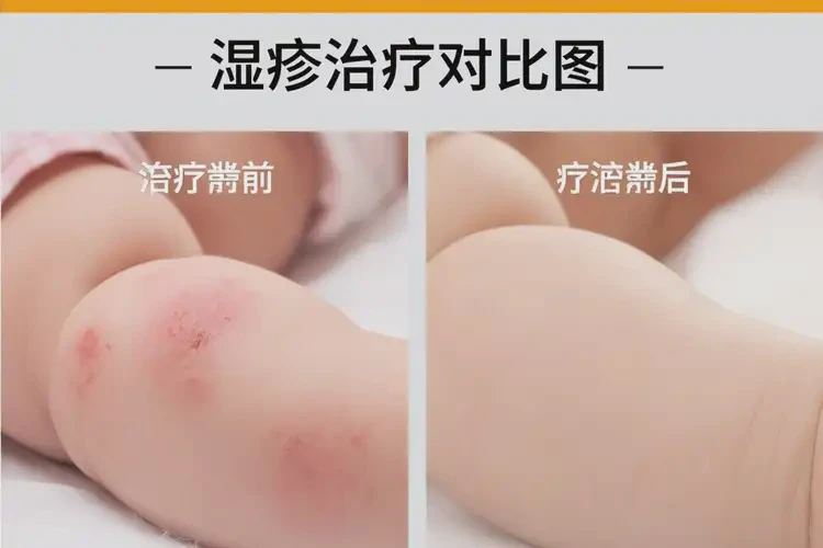 寶寶四肢經(jīng)常長濕疹可以治好嗎(圖4)