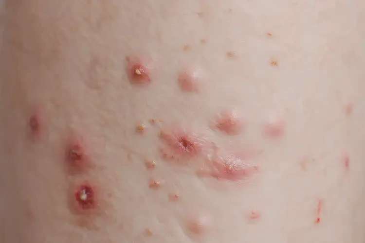 兒童小腿上出現(xiàn)濕疹可不可以根治(圖4)