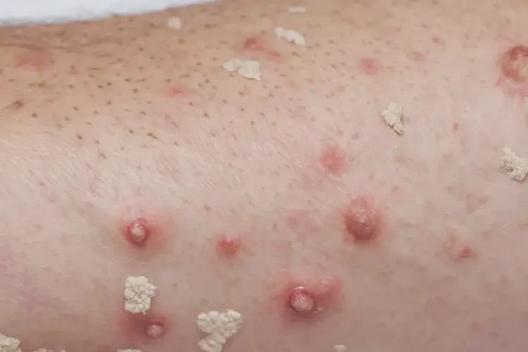 男人手臂容易起濕疹能不能根治(圖4)