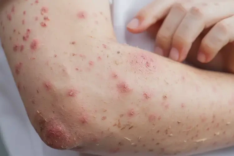 青少年手臂容易起濕疹能夠徹底治愈嗎(圖4)