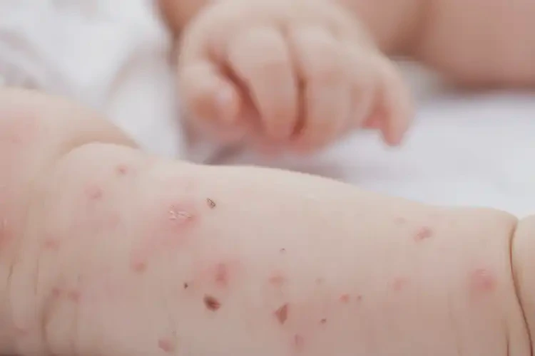 嬰兒四肢出現(xiàn)濕疹可以治好嗎(圖4)