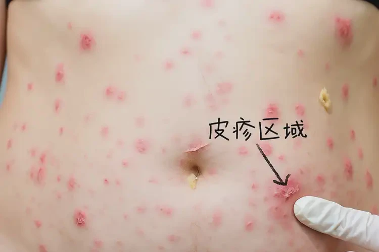 女性肚子出濕疹不管它會自己痊愈嗎(圖4)