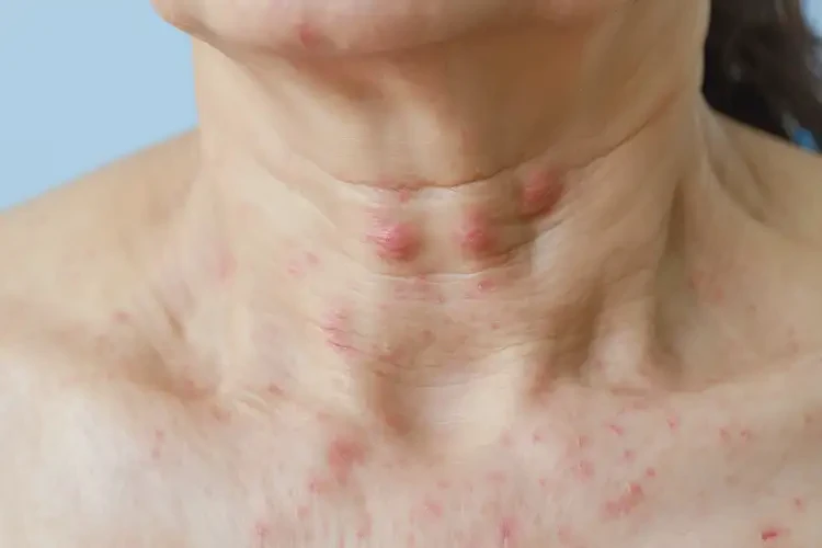 女人脖子經(jīng)常起濕疹能不能根治(圖4)