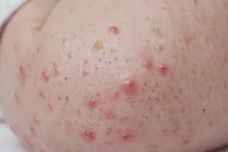 嬰幼兒小腿上有濕疹可不可以根治(圖4)