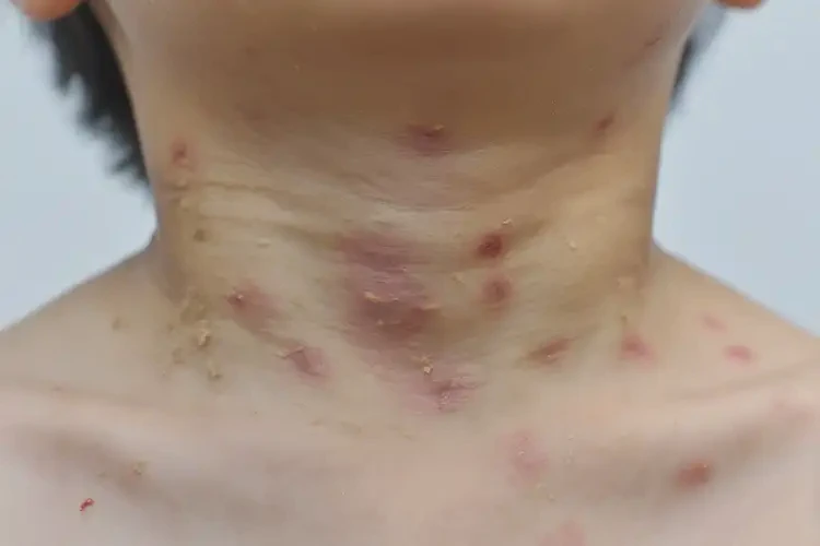 小孩脖子上有濕疹可不可以根治(圖4)