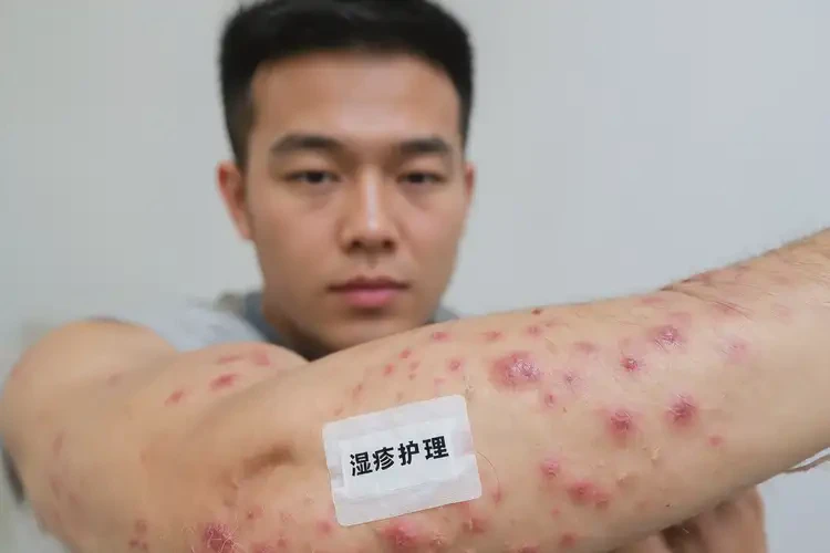 青年人手臂上經(jīng)常長濕疹可不可以根治(圖4)