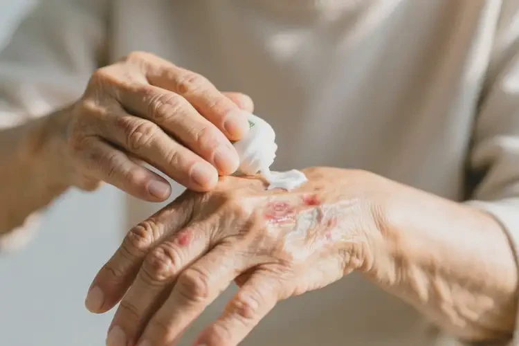 高齡老人手上偶爾長濕疹能不能根治(圖4)