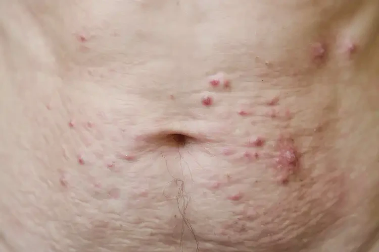 老年人肚子長濕疹可不可以根治(圖4)