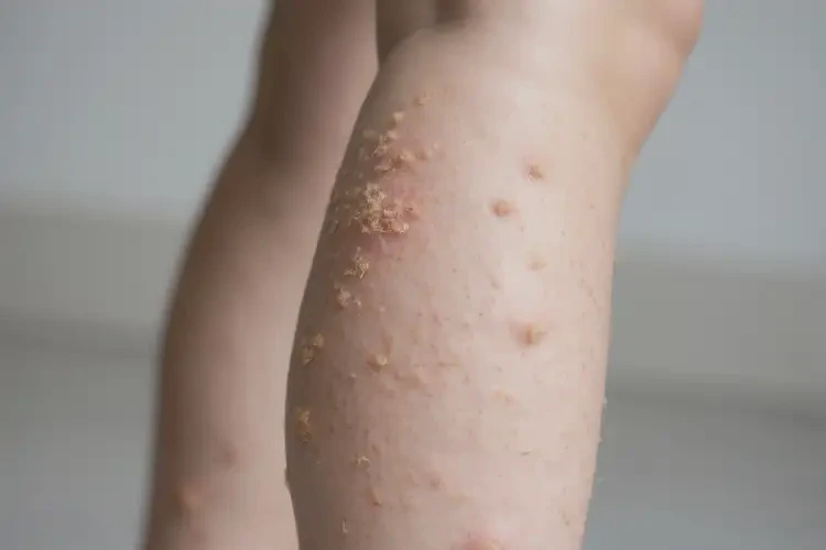 青少年小腿上長(zhǎng)濕疹可不可以徹底自愈(圖4)