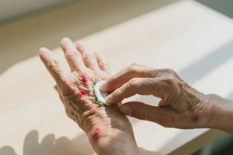 老人手上容易起濕疹可不可以根治(圖4)