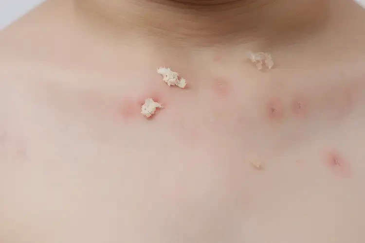 小學生脖子上偶爾長濕疹可不可以根治(圖4)