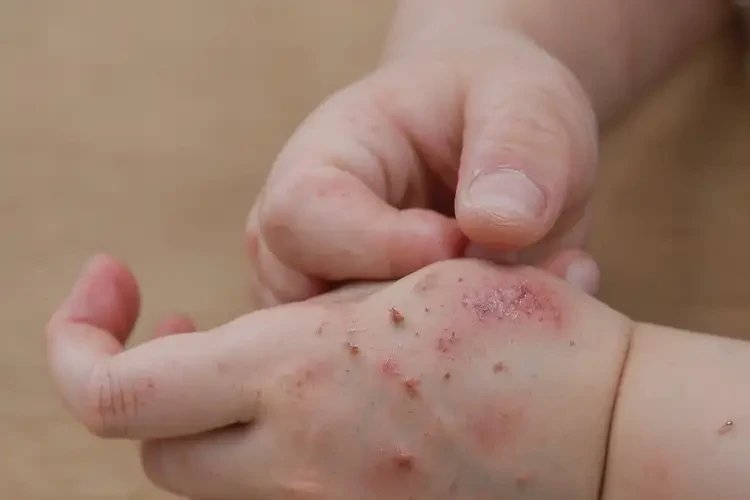 小孩手上长湿疹可不可以根治(图4)