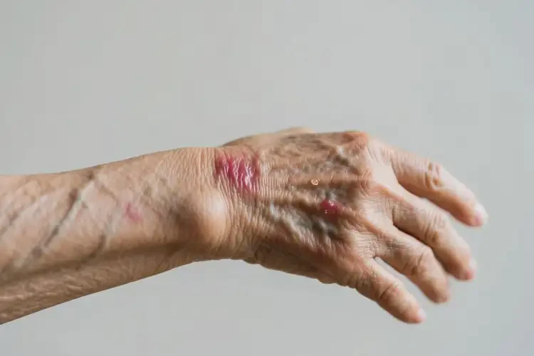 老年人手臂上出濕疹可不可以根治(圖2)