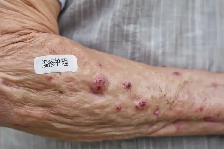 老人手臂上偶爾長濕疹能徹底自愈嗎(圖3)