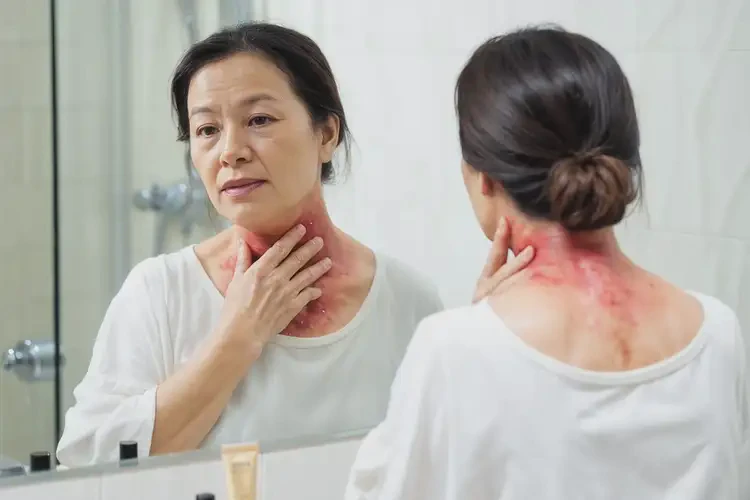 男人脖子上容易長(zhǎng)濕疹能不能根治(圖4)