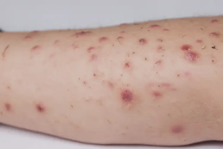 小學(xué)生四肢容易起濕疹不管它會自己好嗎(圖4)