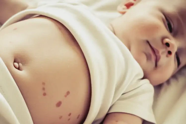 寶寶肚子上長(zhǎng)濕疹可不可以根治(圖3)