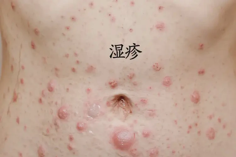 女性肚子上容易起濕疹可不可以根治(圖4)