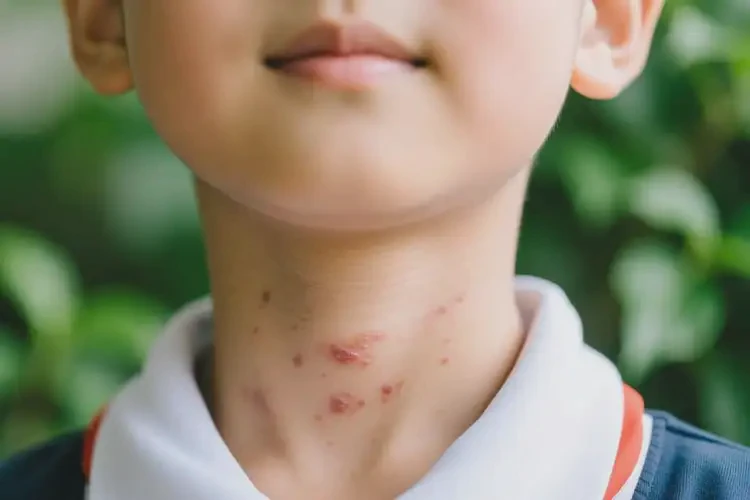 小学生脖子容易长湿疹可不可以根治(图4)