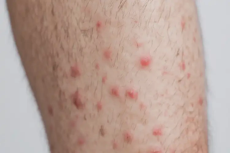 男性大腿起湿疹可不可以根治(图4)