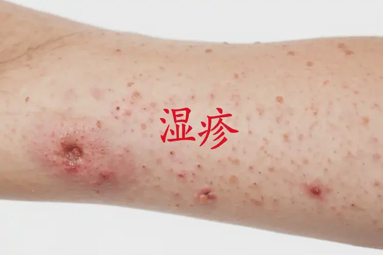 男生肚子經(jīng)常長(zhǎng)濕疹可以徹底自愈嗎(圖4)