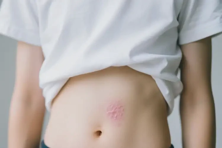 中學生肚子上偶爾長濕疹可不可以根治(圖2)