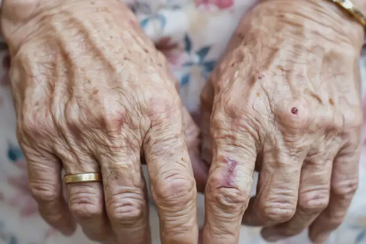 老年人手上出湿疹可不可以根治(图4)