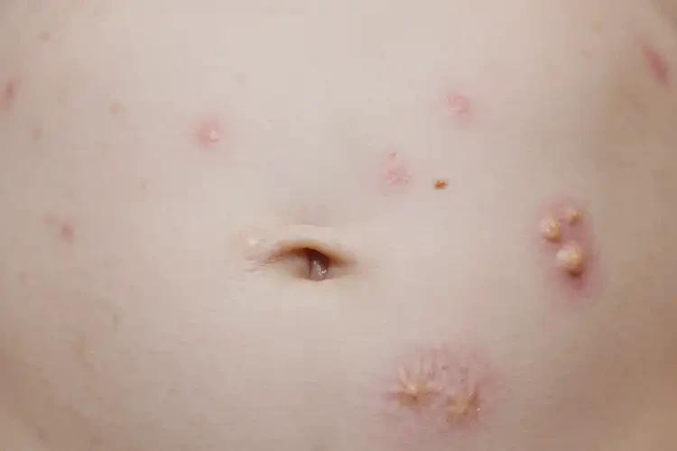 嬰兒肚子上經(jīng)常起濕疹可以治好嗎(圖4)