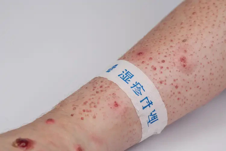 青少年四肢經(jīng)常長濕疹可不可以根治(圖4)