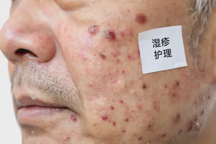 男性屁股上長濕疹能靠自己自愈嗎(圖4)