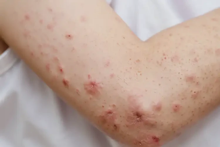 兒童手臂上經(jīng)常長濕疹不管它會(huì)自己自愈嗎(圖4)