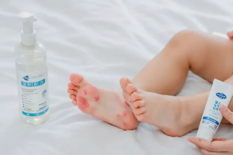 小兒腳上經(jīng)常長(zhǎng)濕疹可不可以根治(圖2)